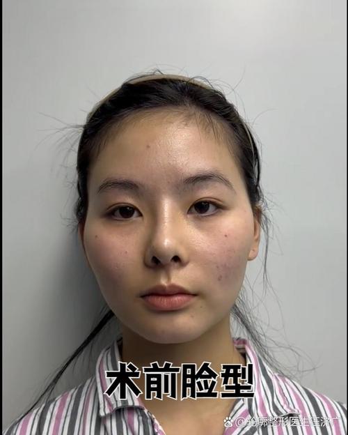 颧弓外扩整形后为什么有人还是觉得不好看？