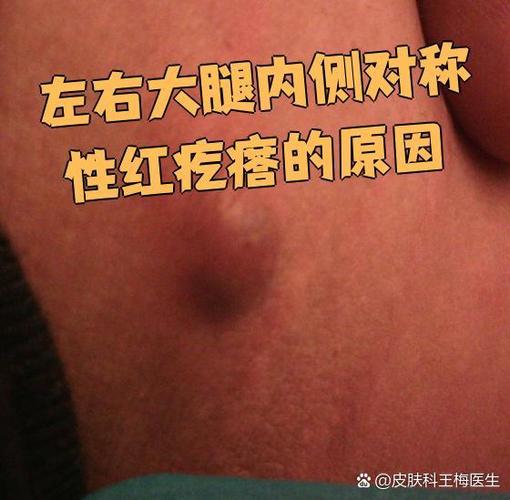 梦见老公身上长满红斑是什么预兆？红色疙瘩的梦境有何特殊含义？