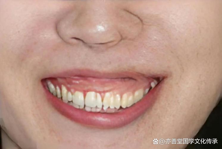 笑露牙龈的面相命运是否吉利，会影响人生运势吗？