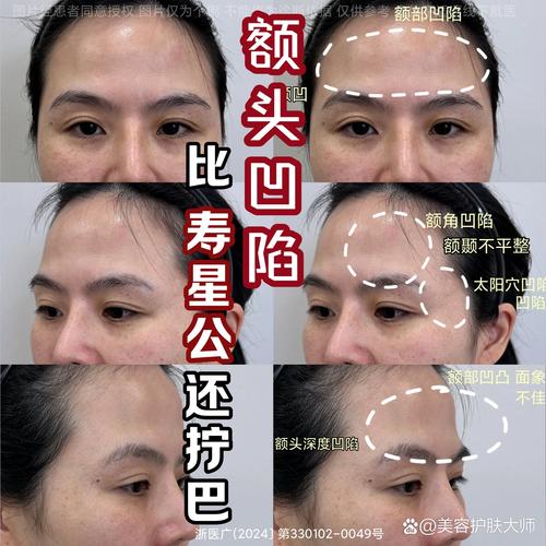 额头凹陷面相有什么特点或影响？