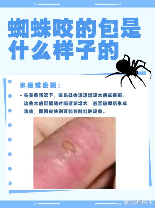 女人梦见蜘蛛咬自己，这究竟是什么不祥的预兆呢？