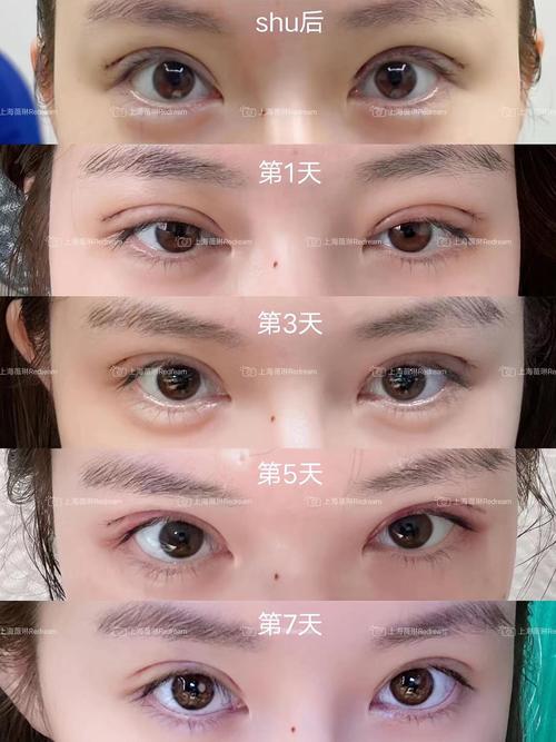 女人割双眼皮会影响运气吗？命运会因此改变吗？