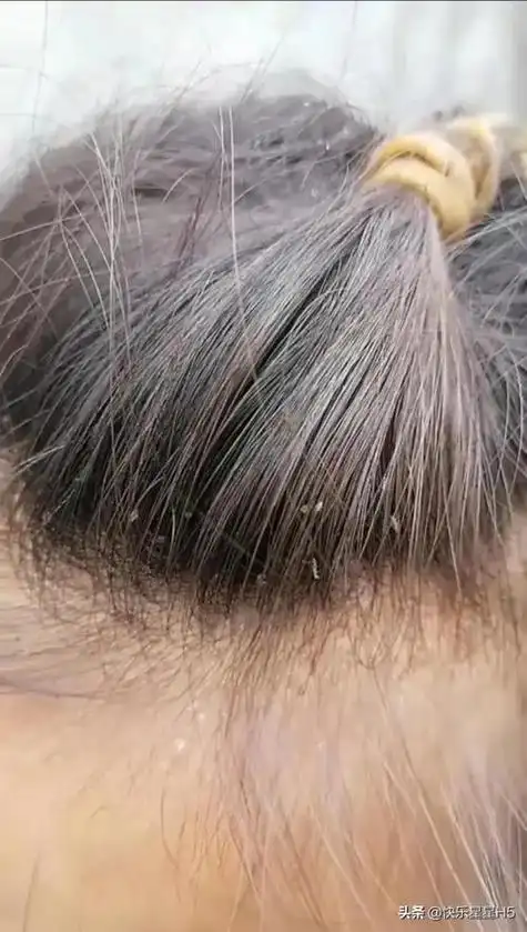 女人梦见自己头上长满虱子是什么寓意或象征？