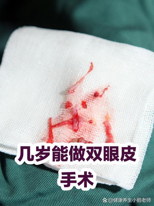 几岁进行双眼皮手术最适宜？