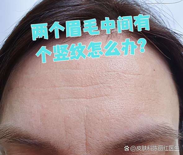 眉毛中间两道竖纹是什么年龄开始出现的？
