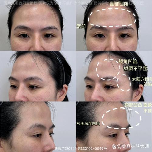 额头凹陷面相有什么特点或影响？