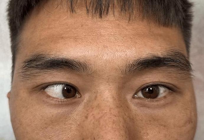 斜视面相的男人命运究竟如何？