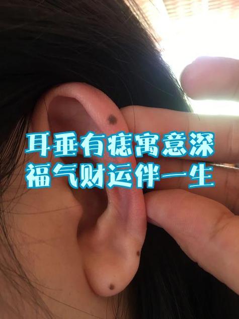 耳垂有痣究竟象征着什么深意？