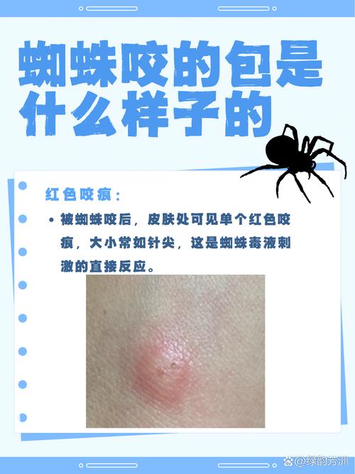 女人梦见蜘蛛咬自己，这究竟是什么不祥的预兆呢？