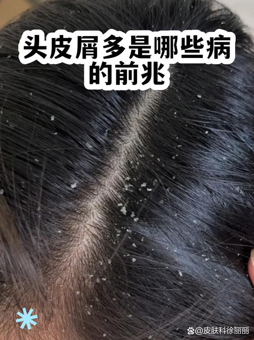 梦见掉头皮屑预示着什么征兆或暗示？