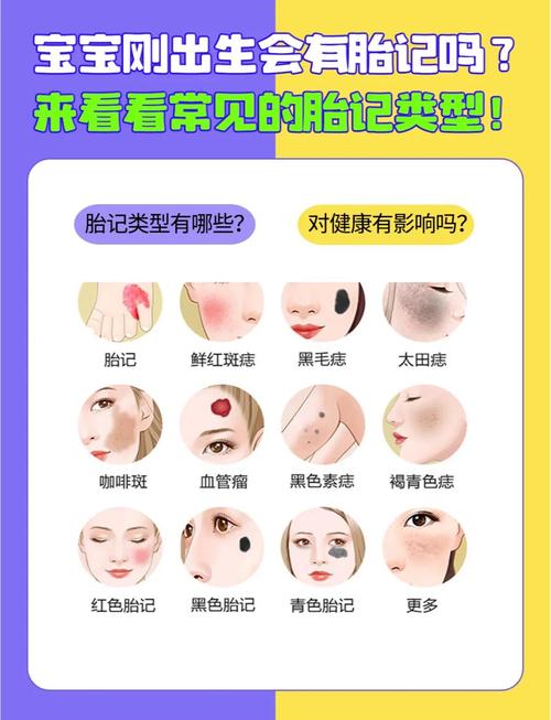 宝宝眉毛附近有胎记怎么办？需要治疗或观察吗？