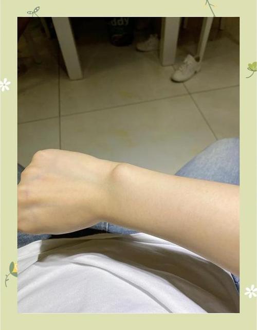胳膊或手腕上的胎记，是否暗示着前世的某种特殊缘分或命运？