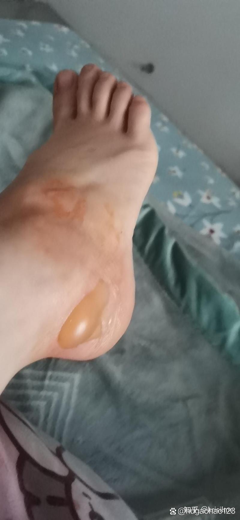 梦见被水烫伤脚有什么特殊预兆或含义？