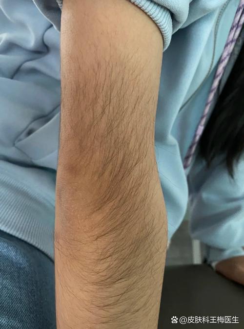 毛发浓密的人命运是否注定一辈子体毛重？