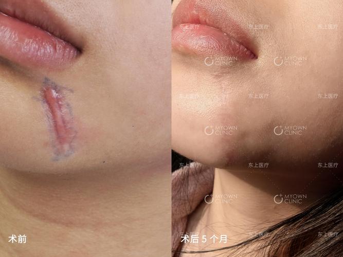 下巴缝针留下的疤痕对面相有何影响？