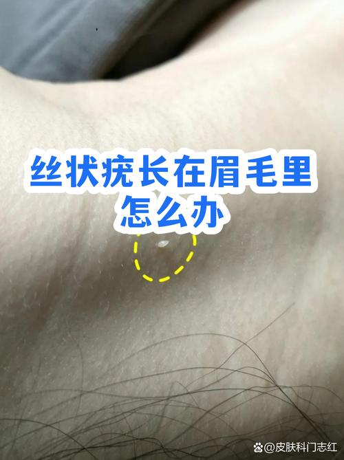 眉毛里长猴子，这瘊子是何来历？