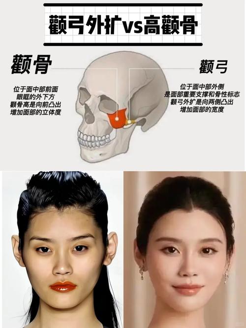 颧弓外扩整形后为什么有人还是觉得不好看？