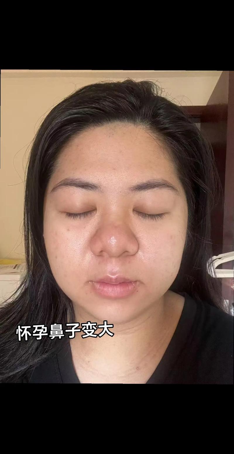 孕期梦见自己整容鼻子是什么预兆？