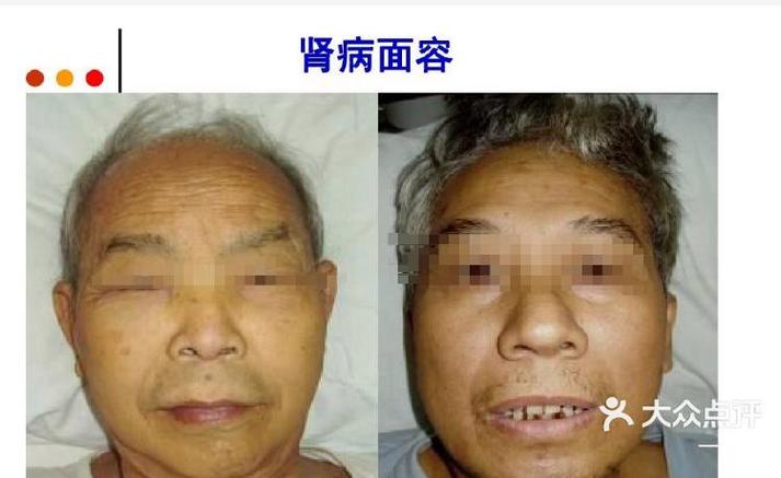 男性患有FSGS这种肾病，面相嫩堪出病情严重到什么程度？