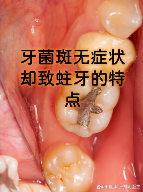 梦见舌头下面牙齿蛀牙是什么征兆或含义？