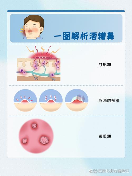 酒糟鼻面相预示命运如何？揭秘酒糟鼻面相好坏对人生的影响