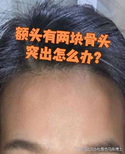女人额头凸起骨头面相是什么？