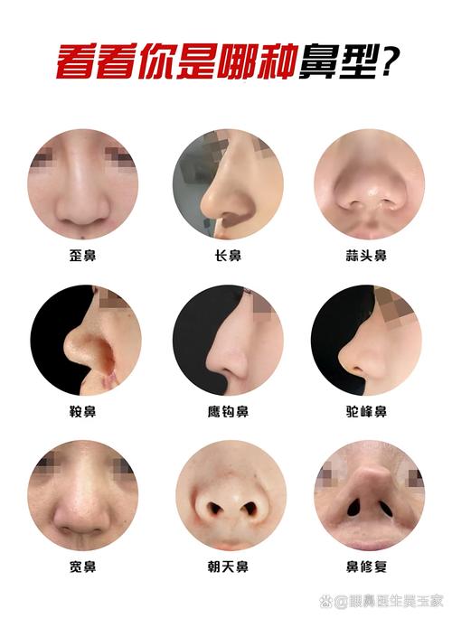 挺鼻子和塌鼻子侧面分别是什么样的？