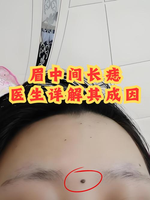 两眉中间长肉痣，有何特殊含义？