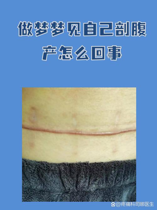 女人Zuo梦剖腹产是什么征兆？剖腹产梦预示着什么？