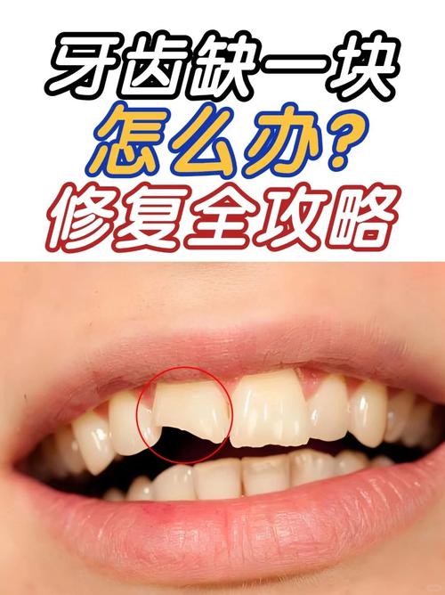 门牙摔缺一小块修复费用大概需要多少？