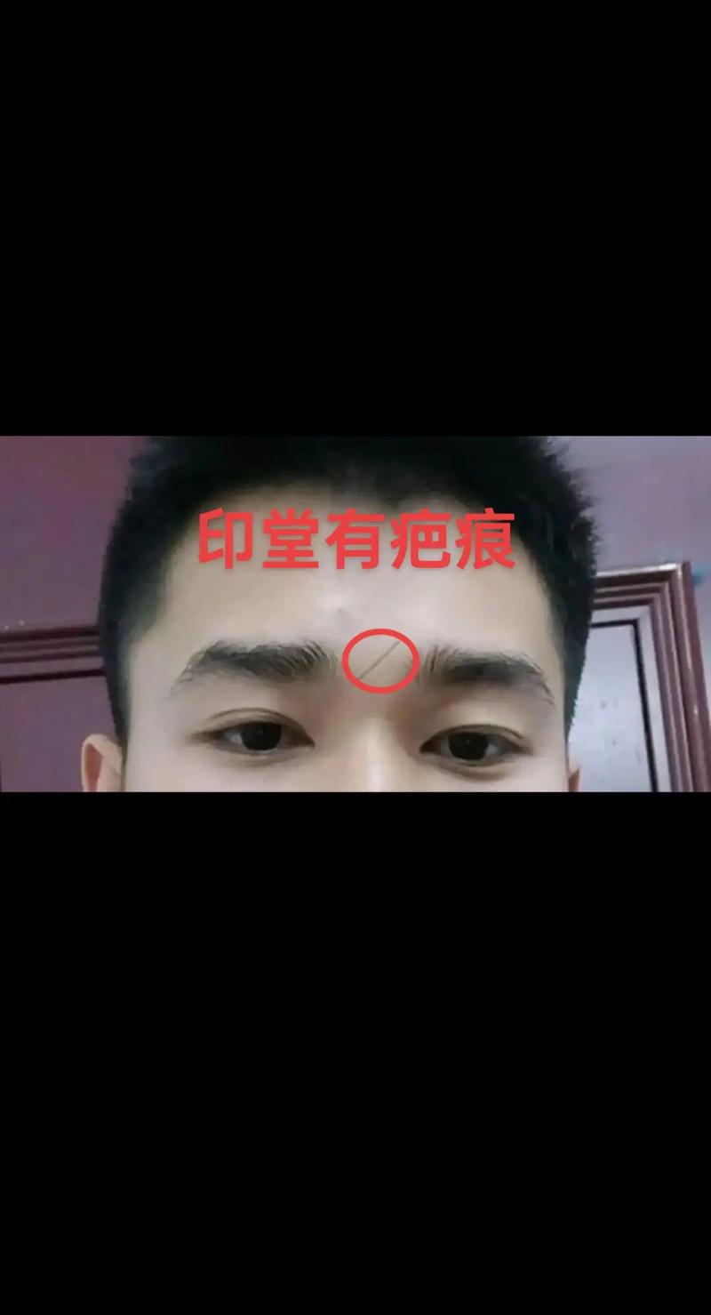 男人太阳穴有疤面相代表什么？