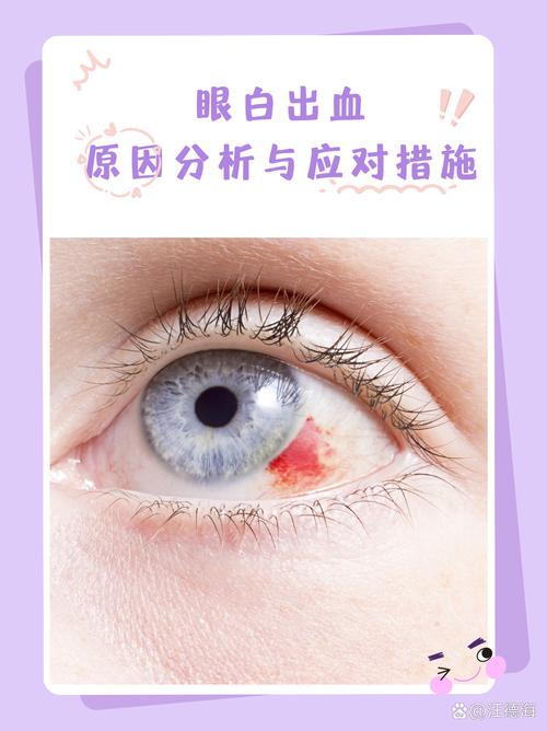 梦见左眼出血预示着什么征兆或含义？