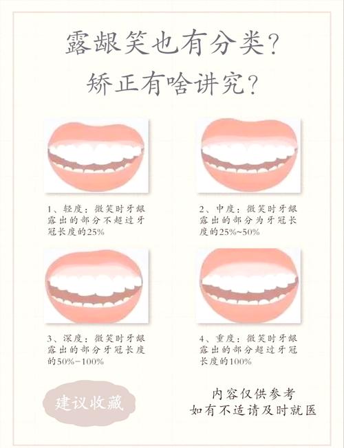 笑露牙龈的面相命运是否吉利，会影响人生运势吗？