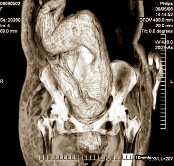 孕妇梦到死人的寓意是什么？