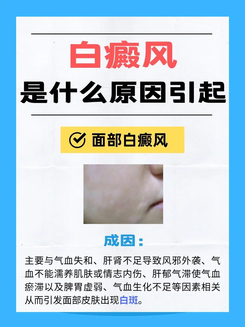 梦见别人患白癜风有什么特殊预兆或含义？
