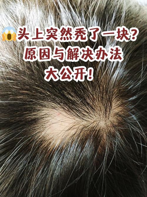 梦见头顶头发秃了一块是什么预兆？