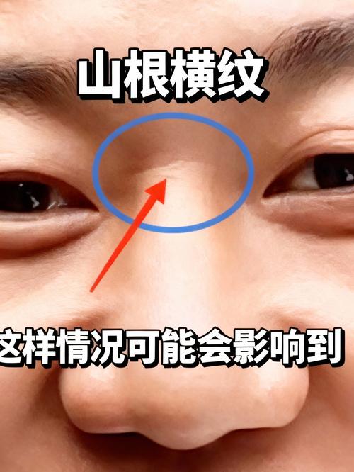 小孩山根有横纹面相代表什么？