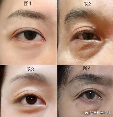 眼皮多褶皱的面相特征有哪些？