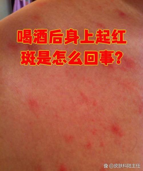 梦见老公身上长满红斑是什么预兆？红色疙瘩的梦境有何特殊含义？