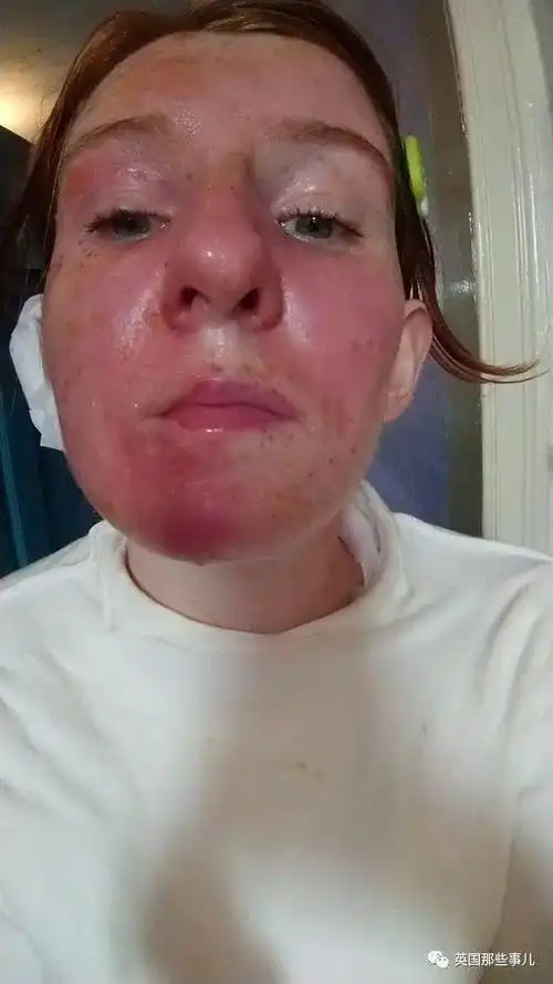 梦见自己脸被火烧毁容了是什么预兆？