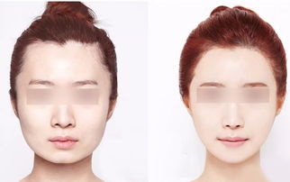 一、 医学角度：面部血管显现的常见原因