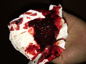 1. 手术不彻底所致残留组织及其连锁反应