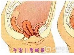一、子宫流黄水到底是怎么回事？