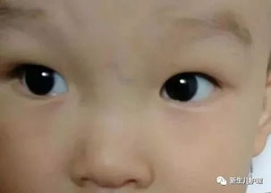 不同人群中右侧瞳孔抖动特点差异化阐述：