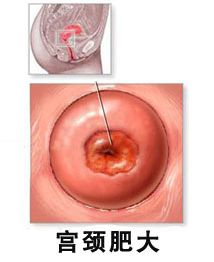第一章：宫颈肥较大的本质与作用于