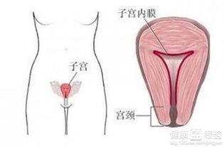 宫腔黏连：异地阻挠