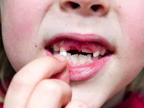 梦见牙齿裂开掉了一部分，这预示着什么？