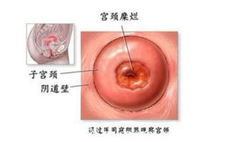 引起宫颈碰触出血的常见原因