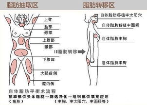 三、 毛发管理与局部脂肪移植相结合的迅速增较宽策略