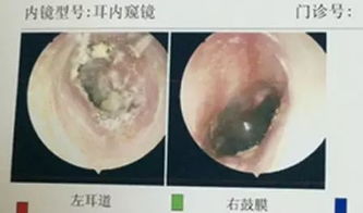 梦见耳朵里掏出大量耳屎预示着什么？